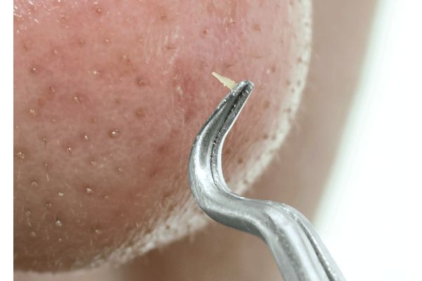 プルオープンピンセット